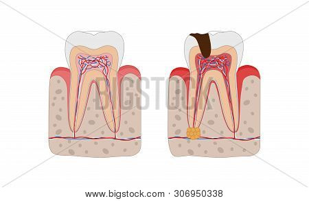 Healthy Tooth And Unhealthy Tooth With Tooth Decay And Dental Abscess Infographic Elements Isolated 