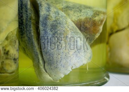 Lungs With Cancerous Changes Floating Inside Jar With Formaldehyde In Morgue