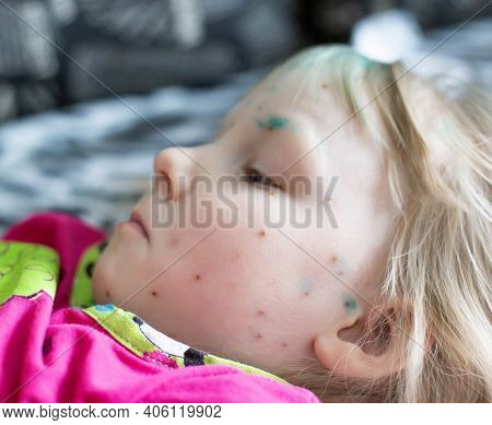 An Infectious Disease In A Little Girl, Chickenpox On Her Face. Treatment Of The Herpes Virus, Chick
