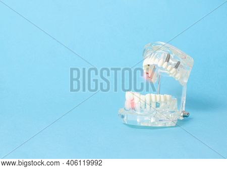 Dental Jaw Model On A Blue Background. Dental Disease Concept, Inflammation And Pain, Gum Redness, G