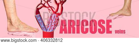 Lower Limb Vascular Examination Because Suspect Of Venous Insufficiency.