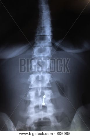 Radiografia della colonna vertebrale - raggi X