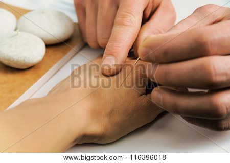 Acupuncture.chinese Medicine Treatmen