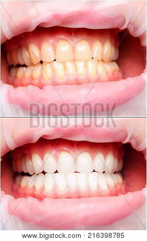 woman tooth before and after studio quality