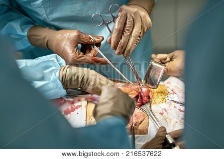 Surgeon is using forceps with a gauze in a cavity of a patient's stomach during the abdominal operation. Assistants are using surgical retractors and suction. Closeup. Horizontal.