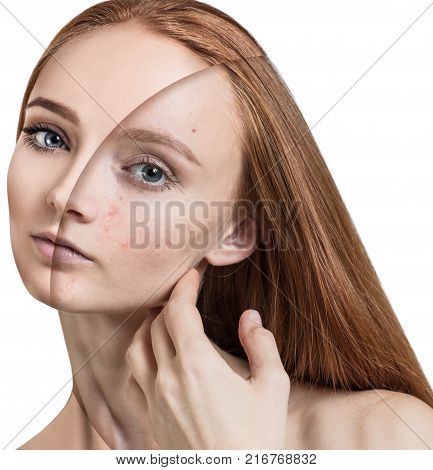 Comparison portrait of young girl with acne before and after treatment and make-up.