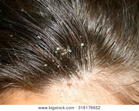 Dandruff On The Hair. Hair Disease Seborrhea. Fatty Dandruff.