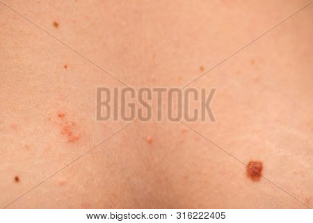 Close Up Picture Of Dangerous Brown Nevus On Human Skin - Melanoma