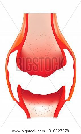 Gout, Human Body. 3d Illustration Transparent Png Images.