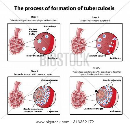 The Process Of Tuberculosis Formation. Infographics. Illustration On Isolated Background.