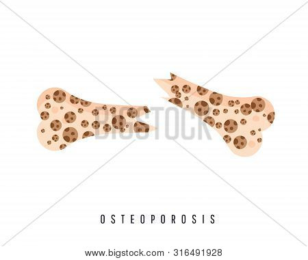 Two Bones Are Normal And Sore.healthy Bone And Broken Bone With Osteoporosis On The White Background