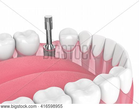 3D Render Of Dental Implant With Multipeg To Check Implant Stability