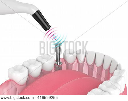 Checking Dental Implant Stability By Osseointegration Monitoring Device