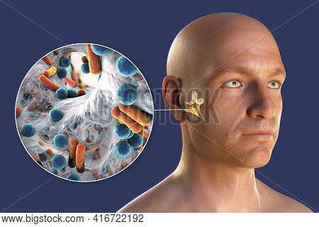 Otitis Media, Inflammatory Disease Of The Middle Ear, 3d Illustration Showing A Person With Highligh