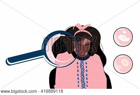 Vitiligo Concept.loupe Zooms Skin Disease.young Afro American Woman With Pigmentation Problem.patchy