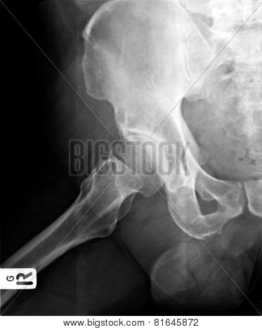 X-ray Image Of Hip