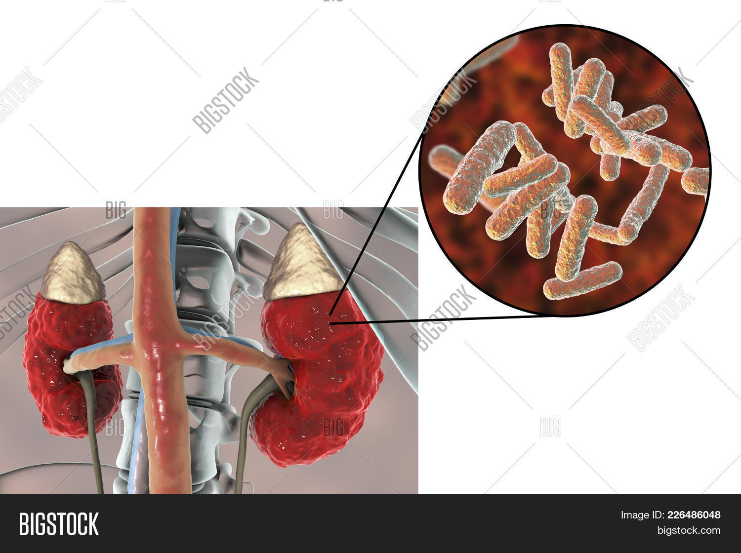 пиелонефрит стафилококк