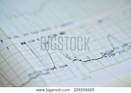 Printing Of Cardiogram Report Coming Out From Electrocardiograph In Labour Ward