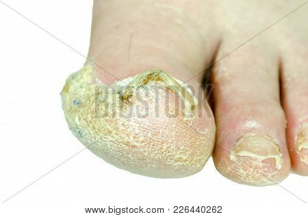Extreme Bad Foot Skin Bacterial Fungal Infection With Damaged Nail Close Up Partially Isolated On Wh