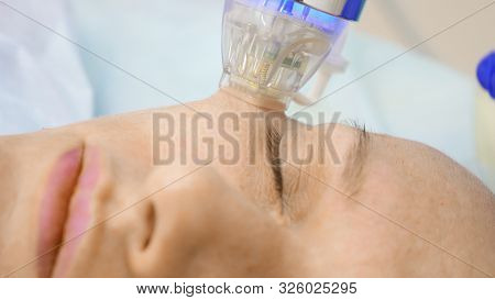 Close-up. Microneedle Rf Lifting Procedure. Hardware Cosmetology. Beautician Conducts A Facial Rejuv