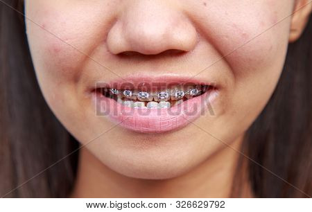Braces To Treat Symptoms Prognathism