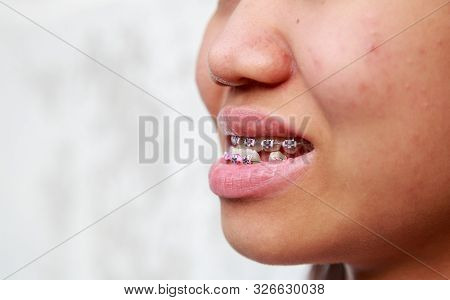 Braces To Treat Symptoms Prognathism