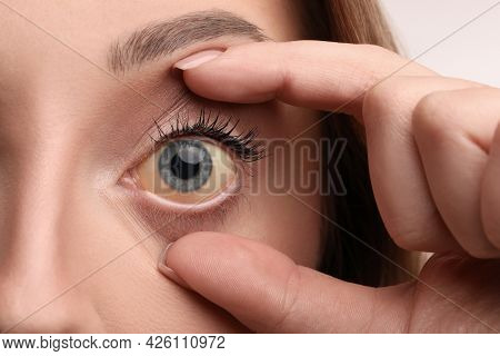 Woman With Yellow Eyes, Closeup. Liver Problems Symptom