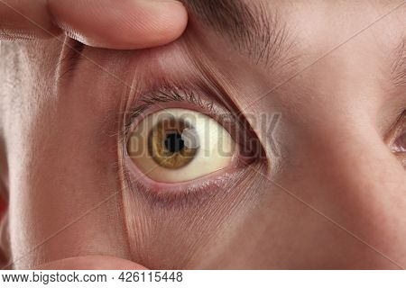 Man Checking His Health Condition, Closeup. Yellow Eyes As Symptom Of Problems With Liver
