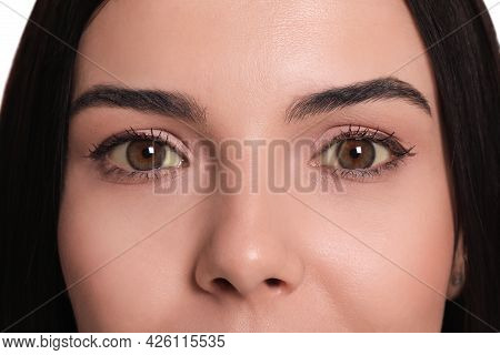 Woman With Yellow Eyes As Background, Closeup. Liver Problems Symptom