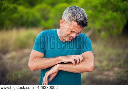 Allergy Or Mosquito Bite. Man Scratcing Arm Outdoor. Healthcare And Medicine Concept