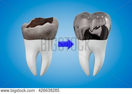 The Concept Of Prosthetics Of A Damaged Tooth With A Metal Crown. Carious Tooth And Dental Crown. De