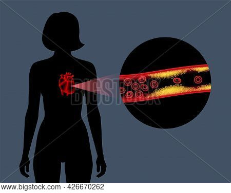 Cholesterol In Human Blood Vessels. Heart Logo In Woman Silhouette. Fat Cells In Vein. High Ldl And 