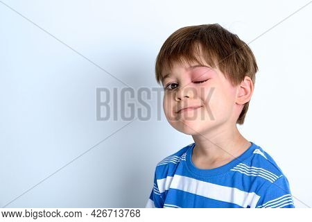 A Boy With Swollen Eye From Insect Bite. Quincke Edema. Portrait Of Caucasian Appearance Child Looki