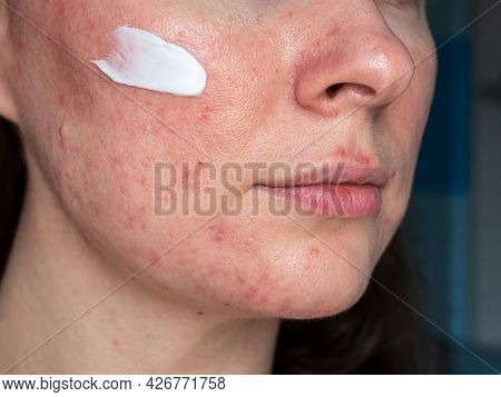 Medicated Ointment On Woman Face With Rosacea Close Up