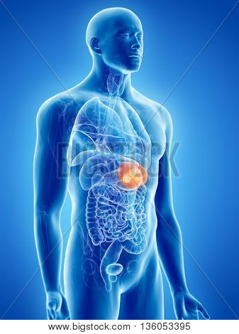 3d rendered, medically accurate illustration of spleen cancer