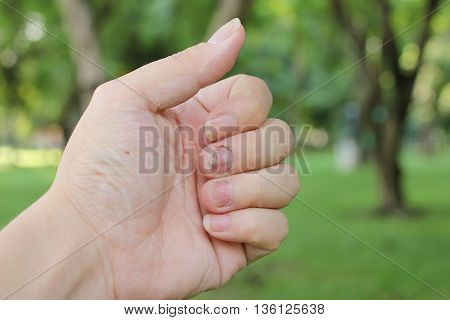Finger With Onychomycosis. A Toenail Fungus.. - Soft Focus
