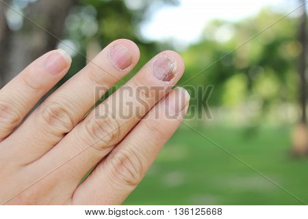 Finger With Onychomycosis. A Toenail Fungus.. - Soft Focus