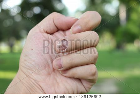 Finger With Onychomycosis. A Toenail Fungus.. - Soft Focus