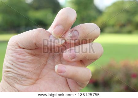 Finger With Onychomycosis. A Toenail Fungus.. - Soft Focus