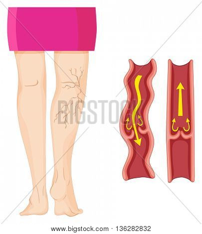 Varicose veins in human leg	  illustration