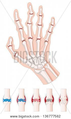Rheumatoid arthritis diagram on white illustration