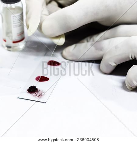 Blood Grouping By Slide Aggutination With A Glass Slide