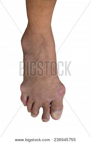 Foot Disease Or Gout Isolated Or White Background.