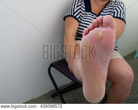 Female Patient Demonstrates The Sole Of The Foot Affected By Dry Calluses And Cracks, Diseases Of Th