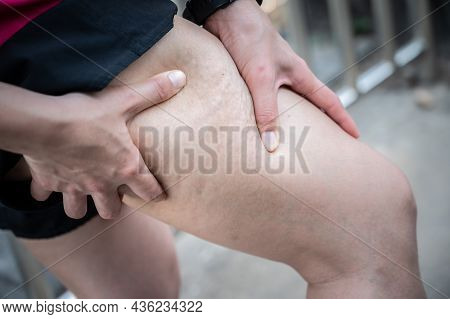 Woman With Cellulite (known As Orange-peel Skin) Problem Appears On Her Legs. Cellulite It Forms Whe