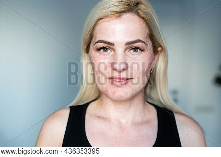 Woman Papules Face, Skin Texture Of Woman.