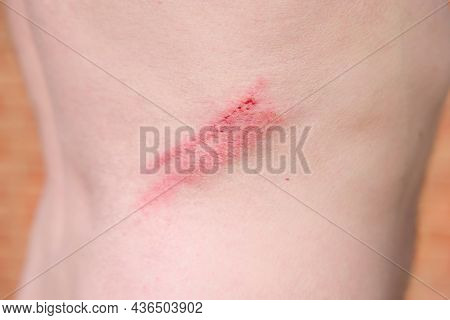 Skin Abrasion Or Graze On A Man's Back. Medical Graze, Injury Or Wound, Uk