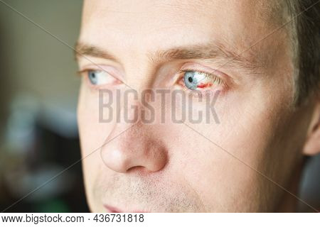 Man Damaged Eye Ball. Conjunctivitis Blood. Allergy Ophtalmology Test. Medical Redness Concept. Asti