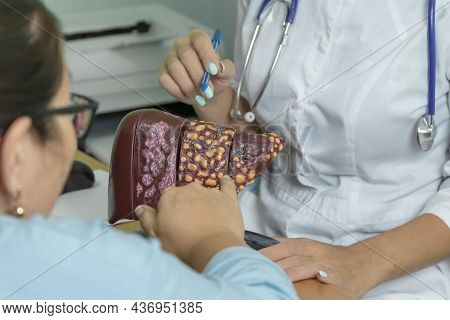 The Patient At The Doctors Appointment Points To The Model Of The Liver. The Doctor Talks About The 