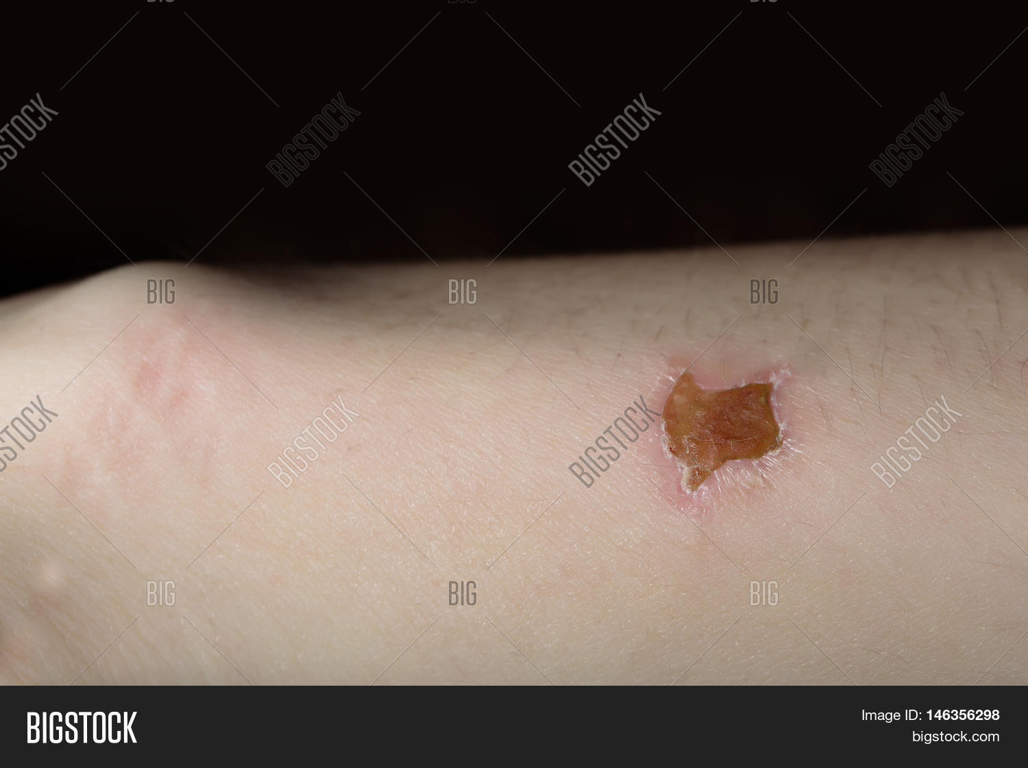 Crust Scratch Wound On Image & Photo (Free Trial) | Bigstock